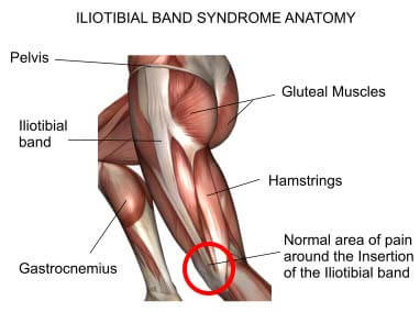 Iliotibal Band Syndrome, Total Pain Care